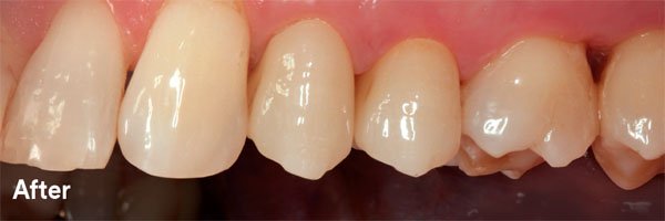 Lava Esthetic Zirconia – GB Dental Lab